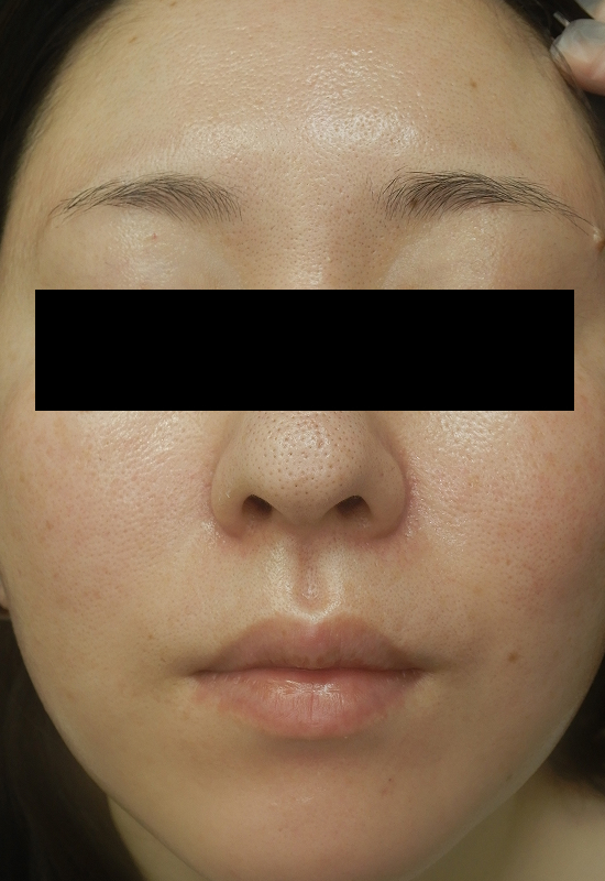 毛穴・赤ら顔改善症例アフター