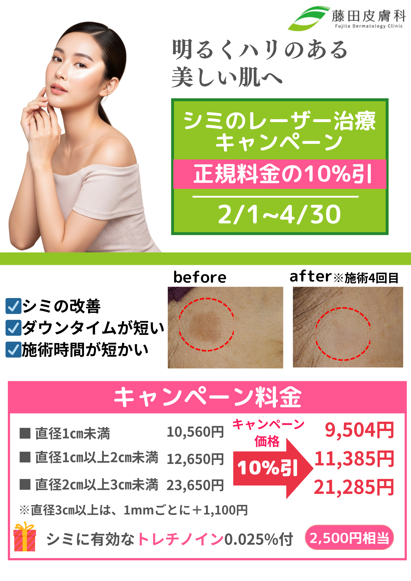 シミのレーザー治療キャンペーン（春に向けてのキャンペーン掲示物）